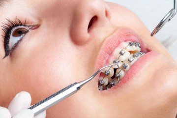 戴牙套感觉鼻子疼牙套副作用都有哪些